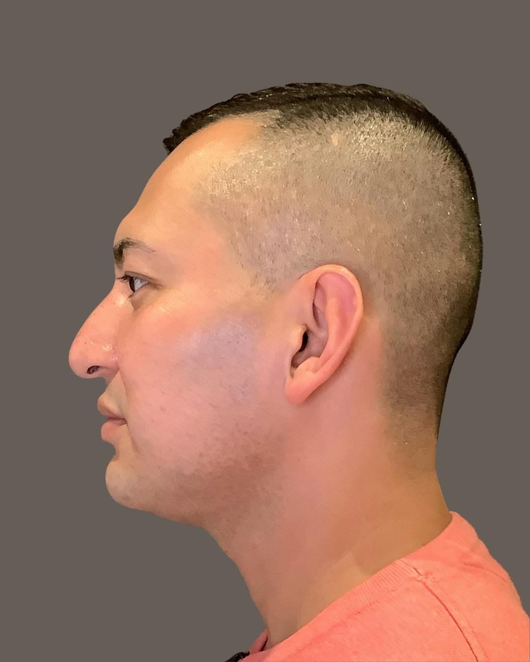 Rhinoplasty Before & After Gallery - Patient 748574 - Image 9