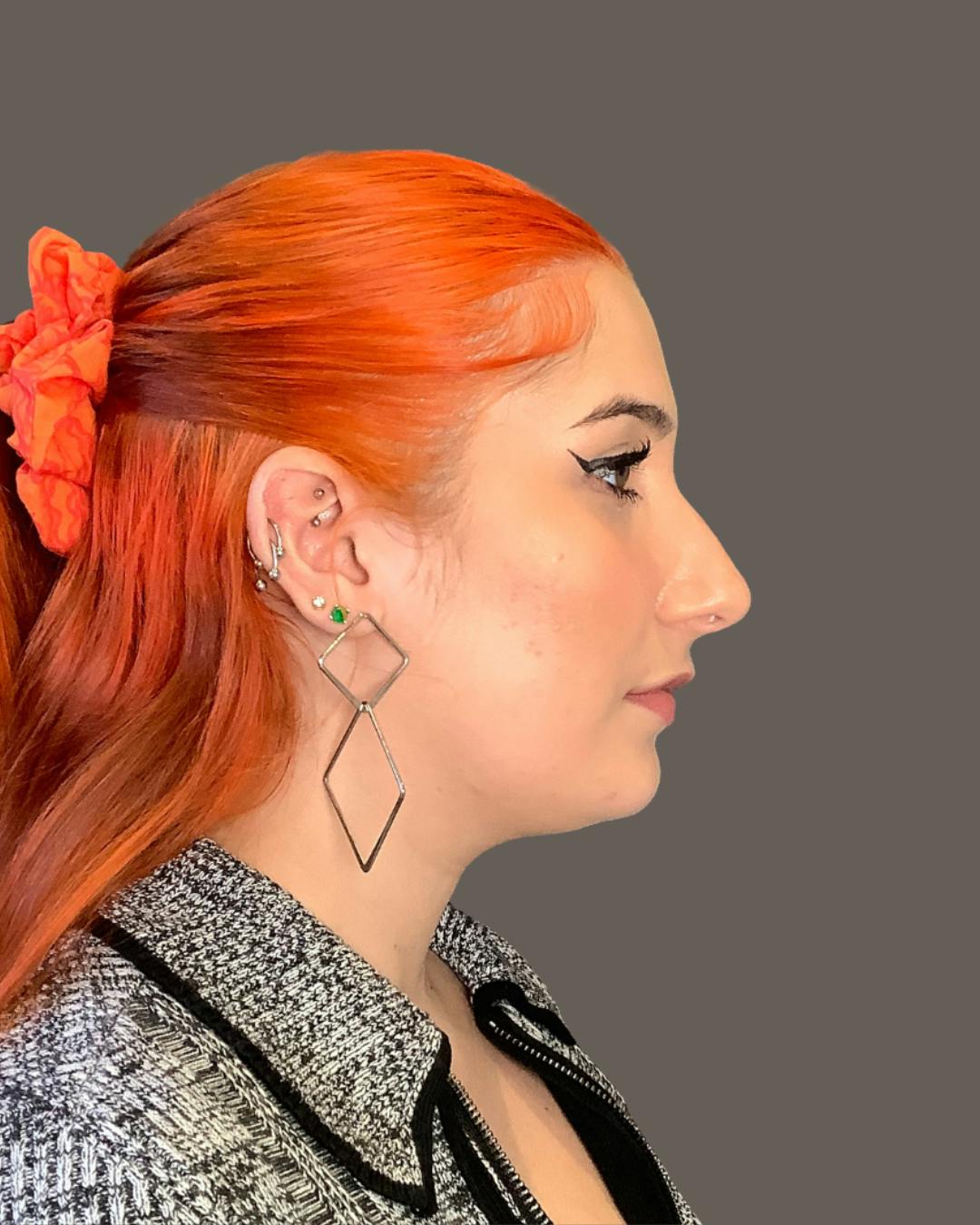 Rhinoplasty Before & After Gallery - Patient 143120 - Image 1
