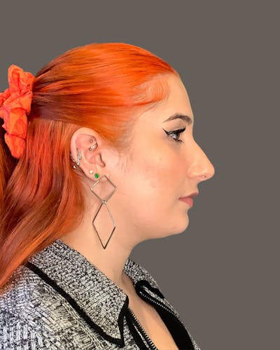 Rhinoplasty Before & After Gallery - Patient 143120 - Image 1