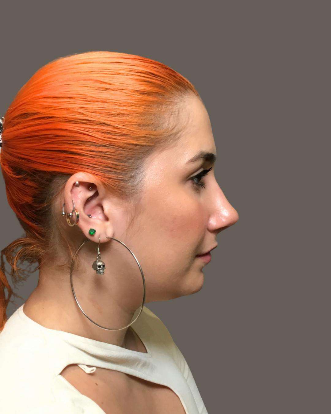 Rhinoplasty Before & After Gallery - Patient 143120 - Image 2