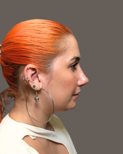 Rhinoplasty Before & After Gallery - Patient 143120 - Image 2