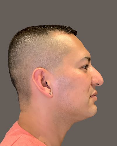 Rhinoplasty Before & After Gallery - Patient 748574 - Image 1