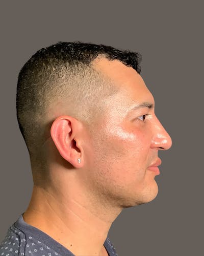 Rhinoplasty Before & After Gallery - Patient 748574 - Image 2