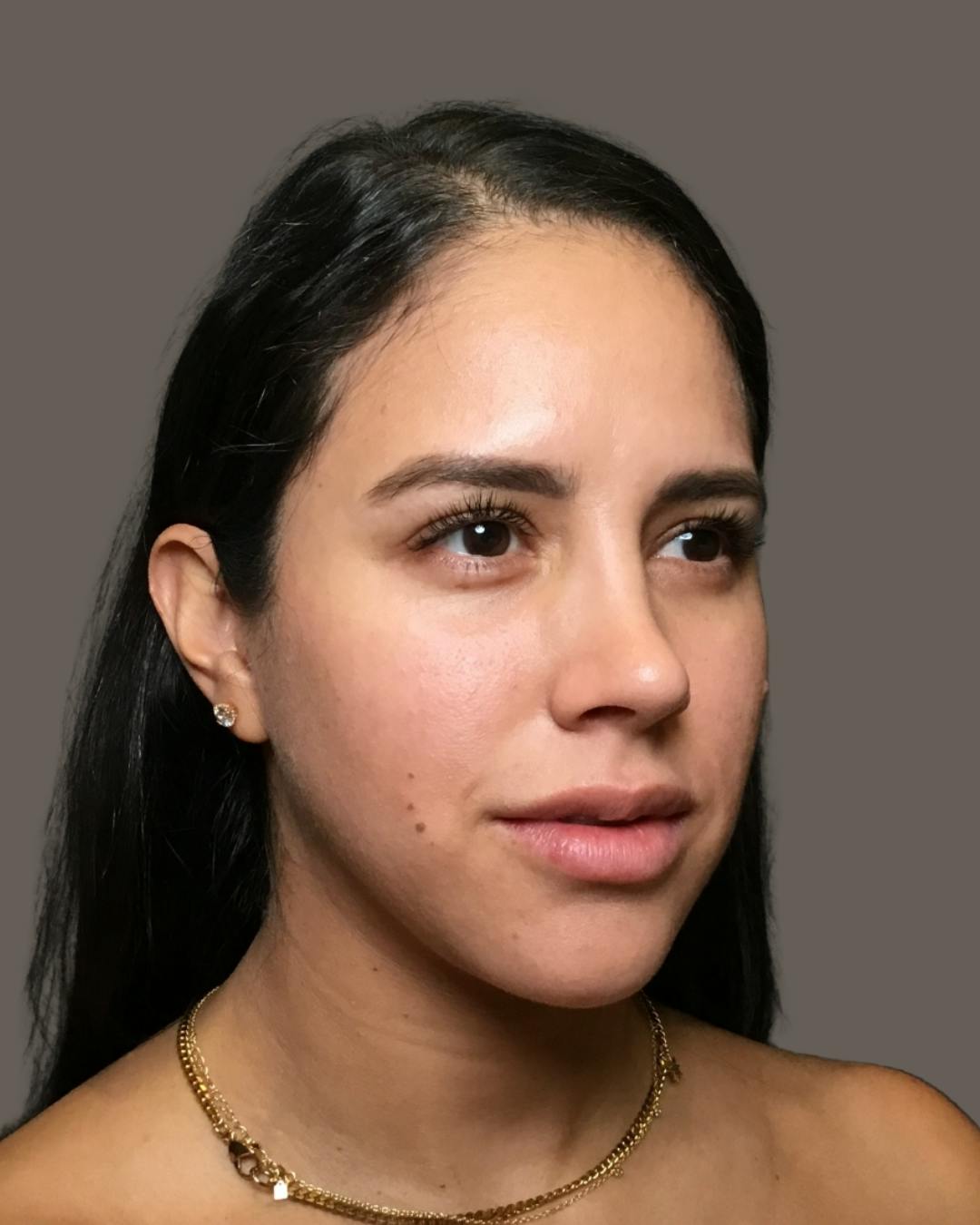 Rhinoplasty Before & After Gallery - Patient 139164 - Image 4