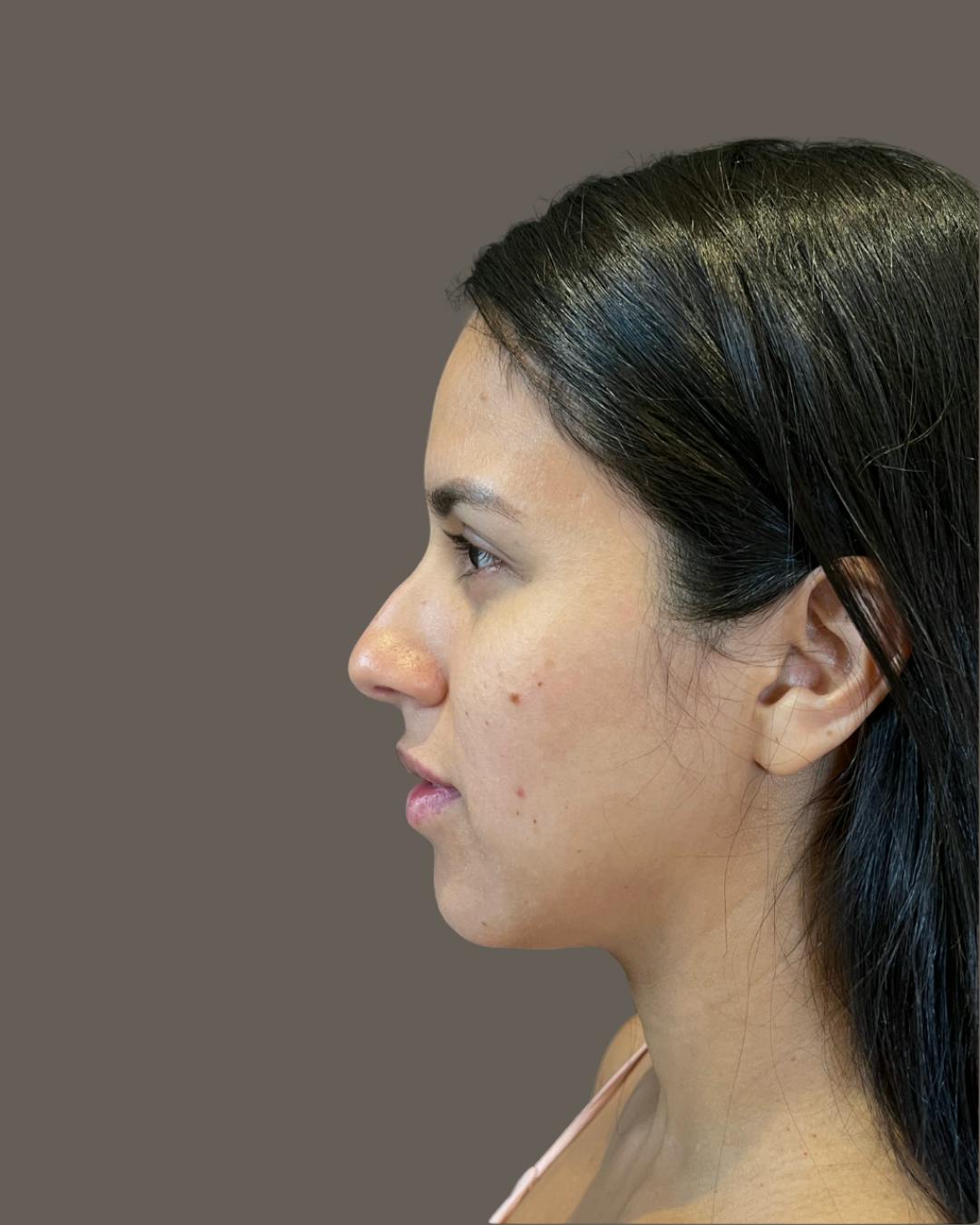 Rhinoplasty Before & After Gallery - Patient 139164 - Image 9