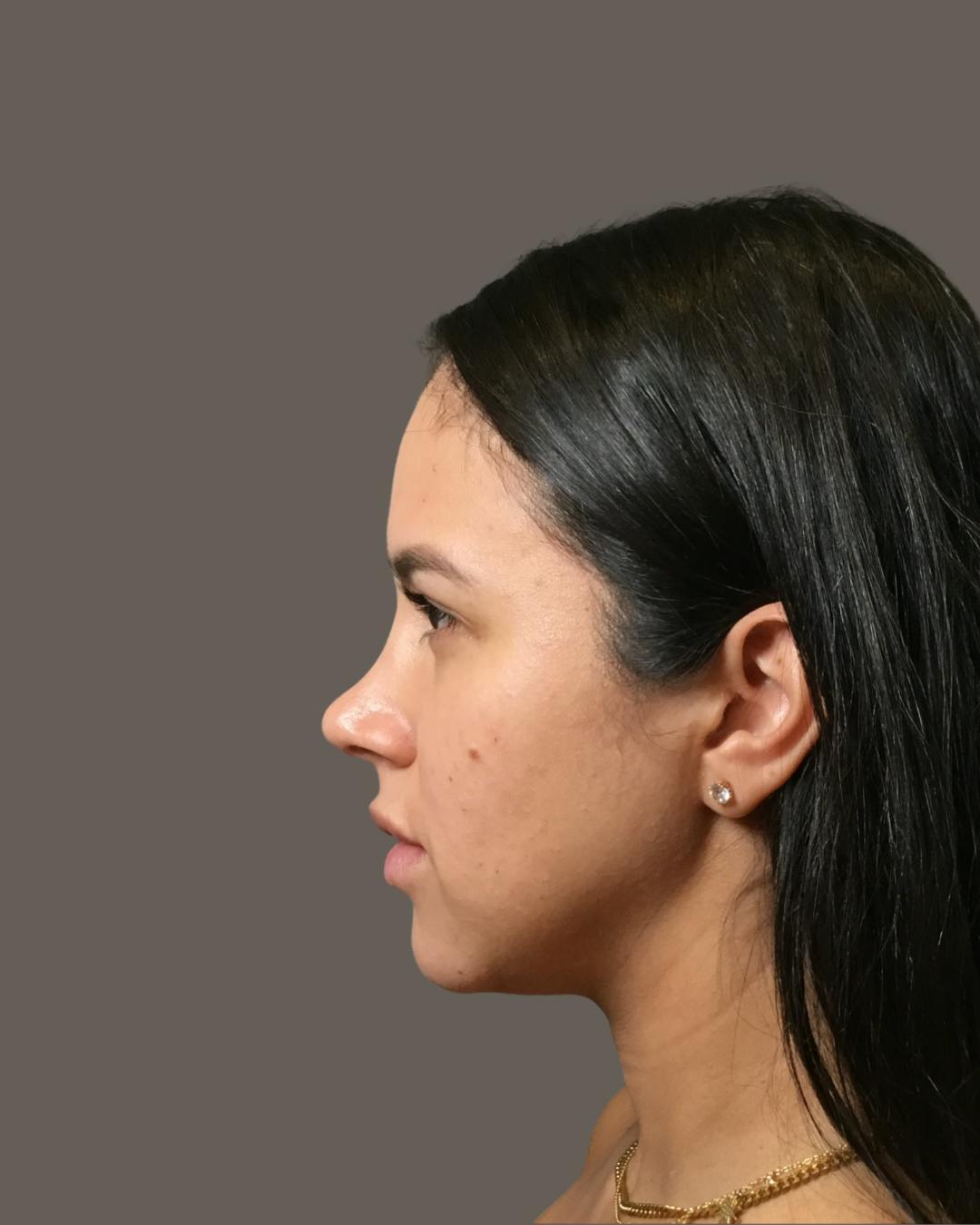 Rhinoplasty Before & After Gallery - Patient 139164 - Image 10