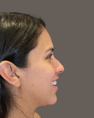 Rhinoplasty Before & After Gallery - Patient 139164 - Image 1