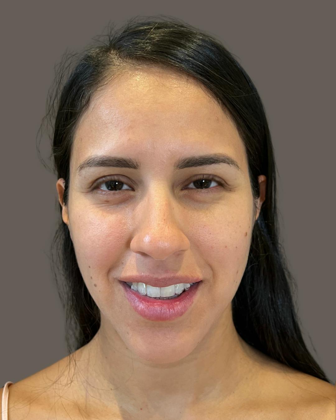 Rhinoplasty Before & After Gallery - Patient 139164 - Image 5