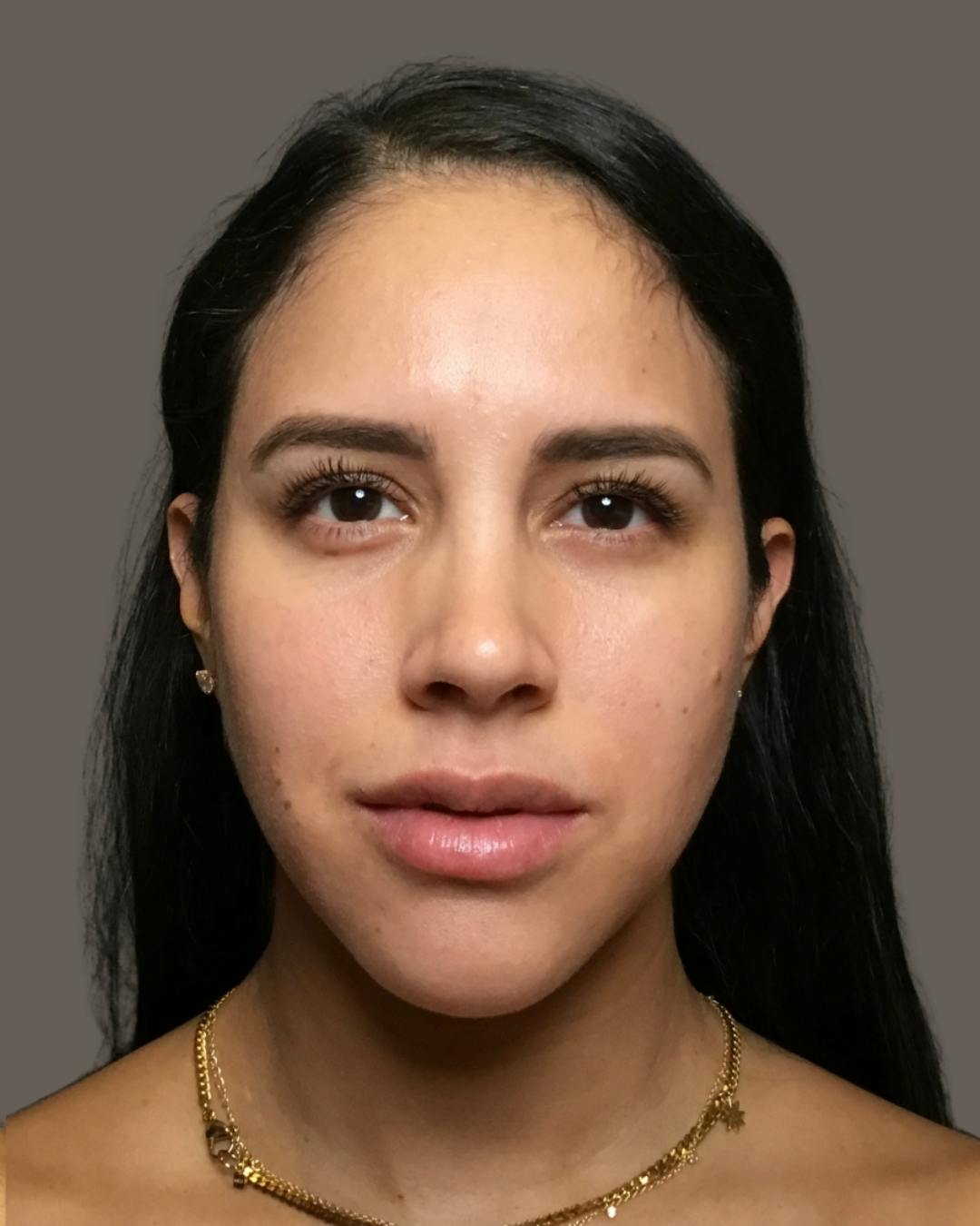 Rhinoplasty Before & After Gallery - Patient 139164 - Image 6