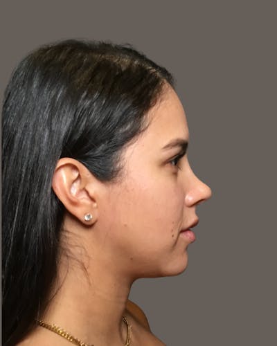 Rhinoplasty Before & After Gallery - Patient 139164 - Image 2