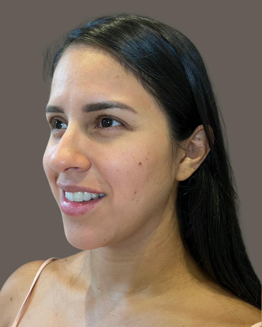 Rhinoplasty Before & After Gallery - Patient 139164 - Image 7