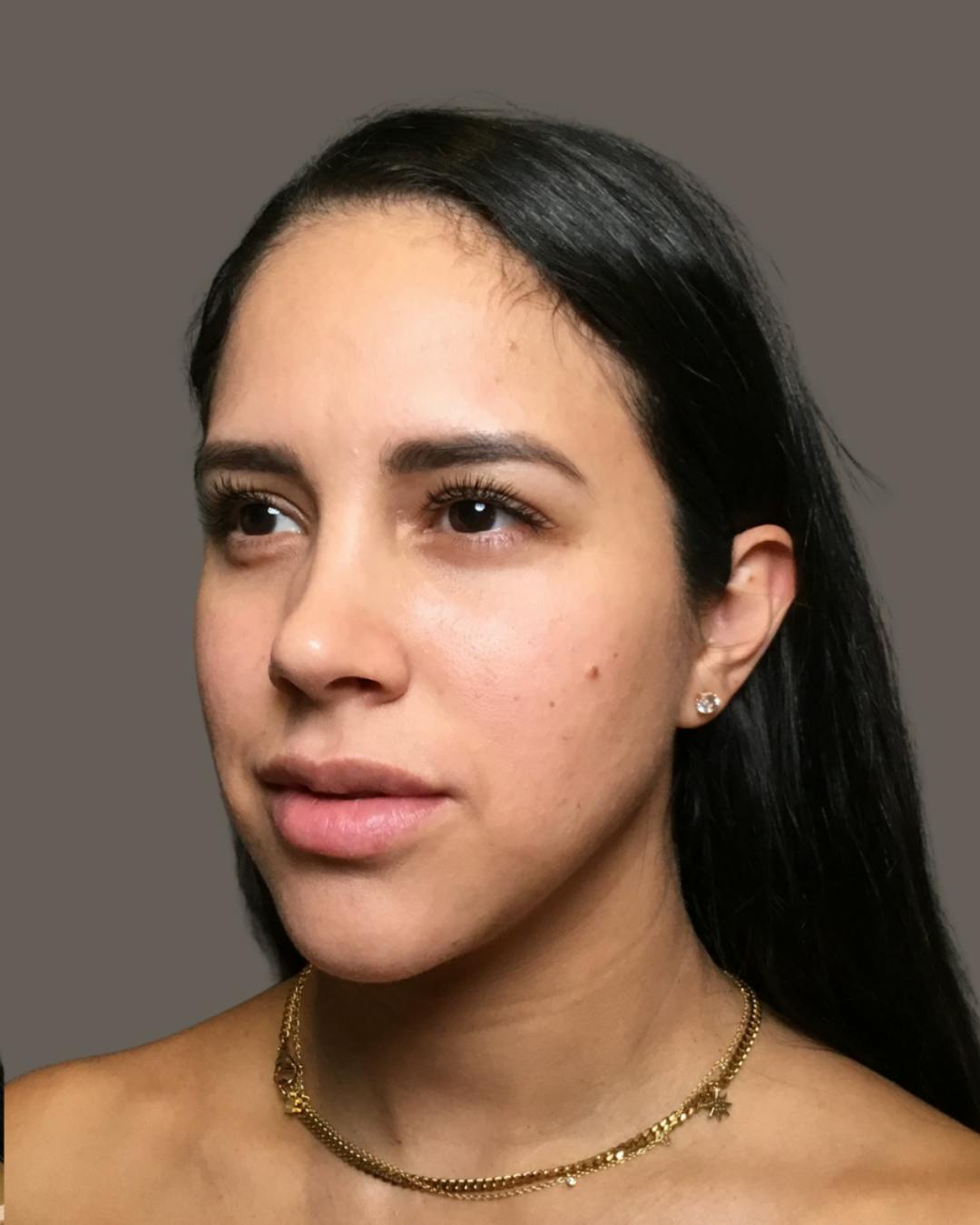 Rhinoplasty Before & After Gallery - Patient 139164 - Image 8