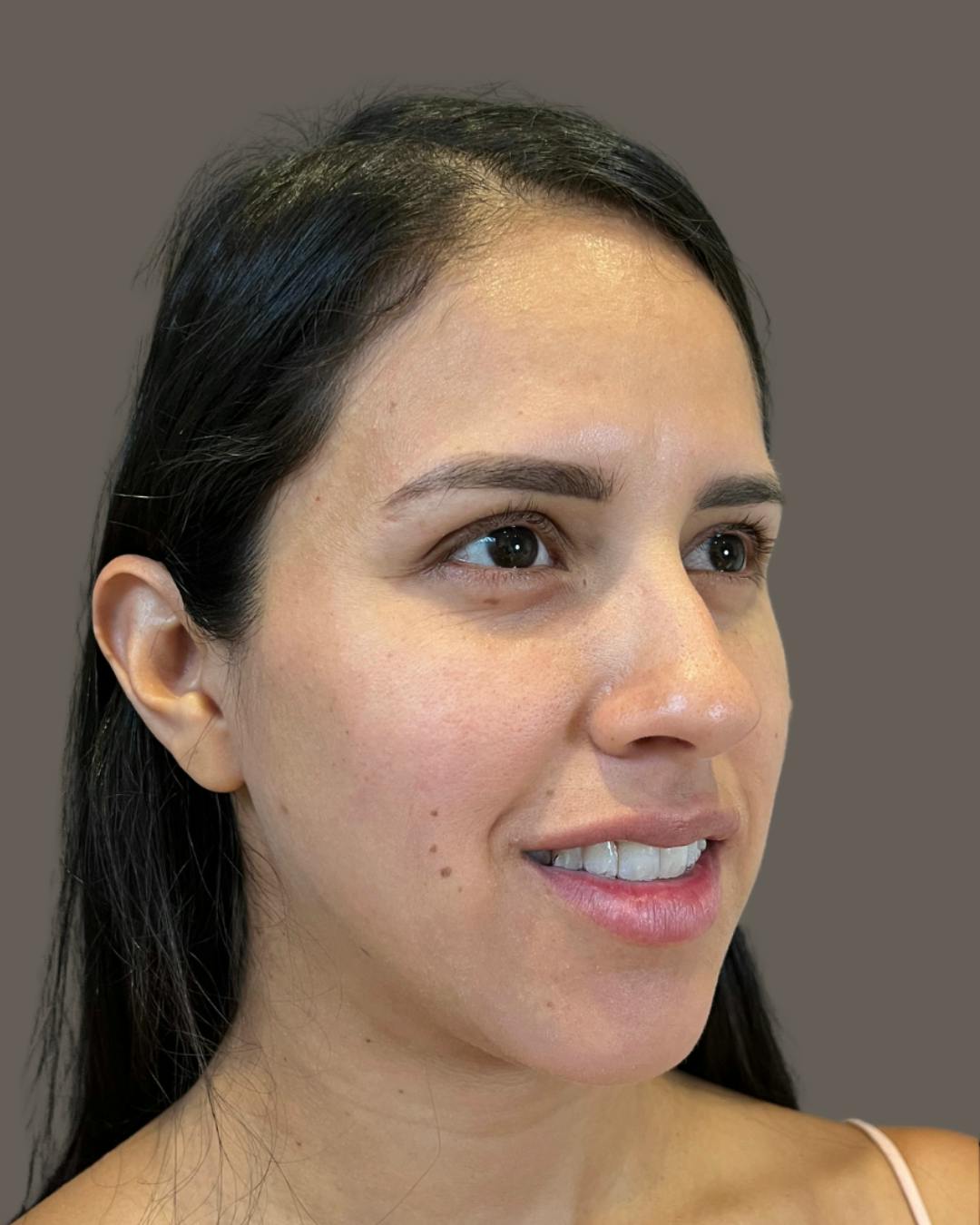 Rhinoplasty Before & After Gallery - Patient 139164 - Image 3