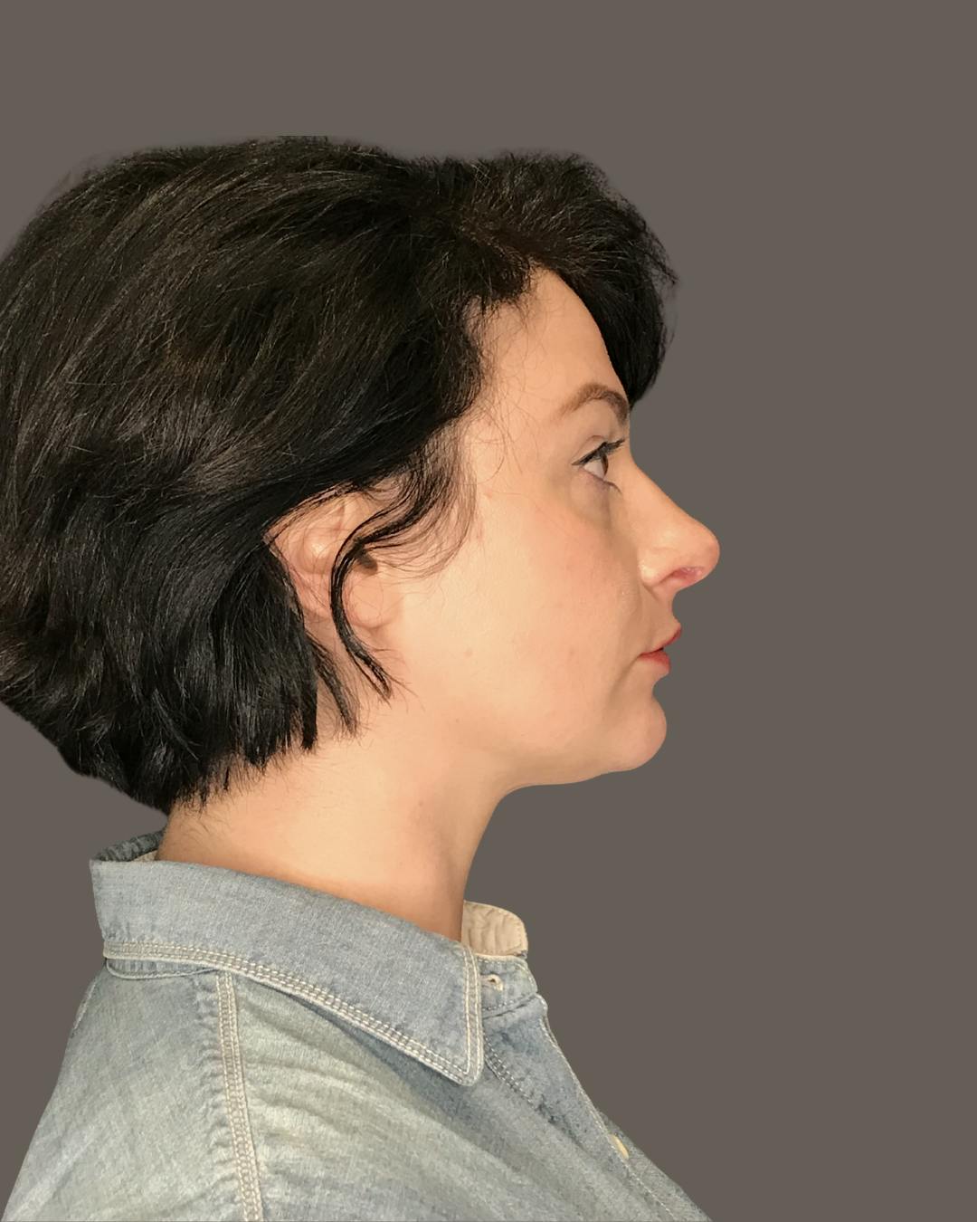 Rhinoplasty Before & After Gallery - Patient 151521036 - Image 2