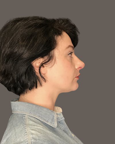 Rhinoplasty Before & After Gallery - Patient 151521036 - Image 2