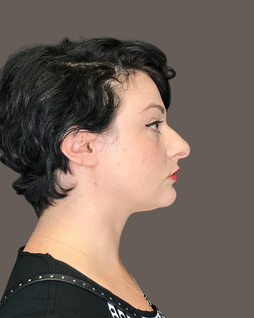 Rhinoplasty Before & After Gallery - Patient 151521036 - Image 1
