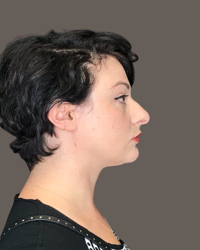 Rhinoplasty Before & After Gallery - Patient 151521036 - Image 1