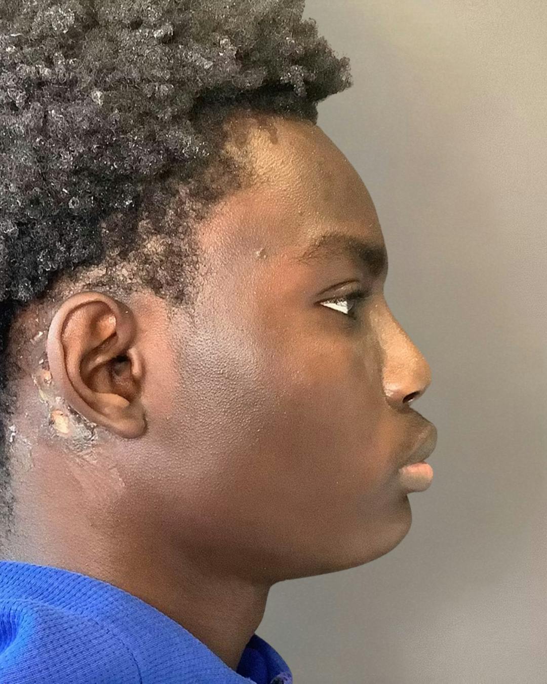 Rhinoplasty Before & After Gallery - Patient 788730 - Image 1