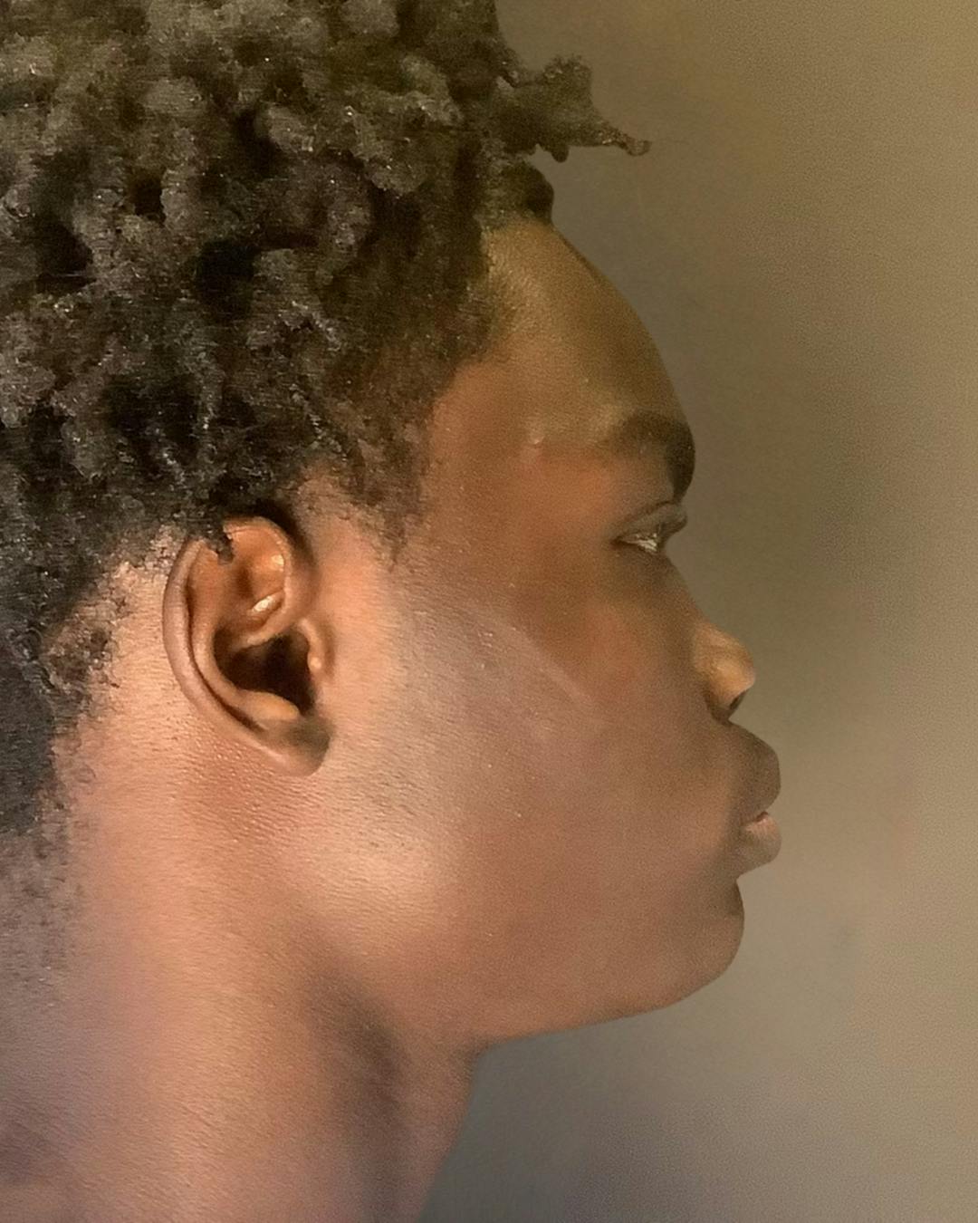 Rhinoplasty Before & After Gallery - Patient 788730 - Image 2