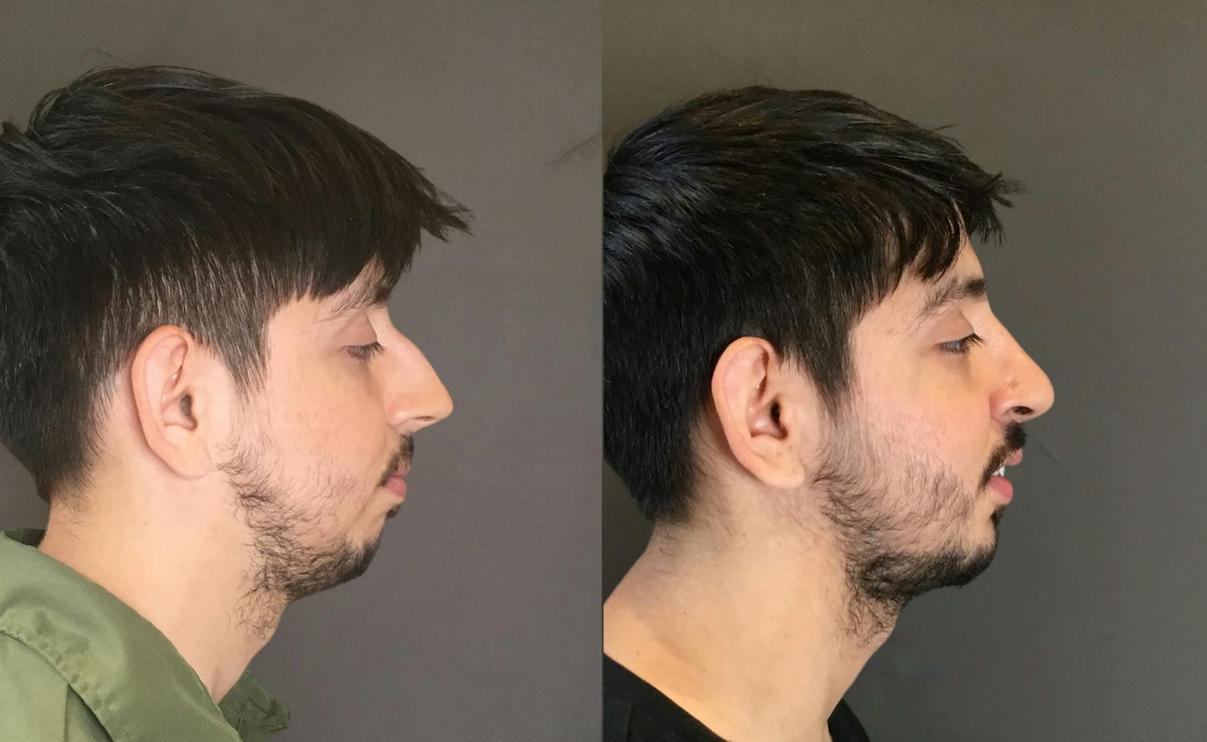 Rhinoplasty Before & After Gallery - Patient 165207 - Image 1