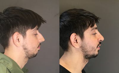 Rhinoplasty Before & After Gallery - Patient 165207 - Image 1