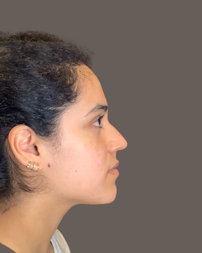 Rhinoplasty Before & After Gallery - Patient 320671 - Image 1
