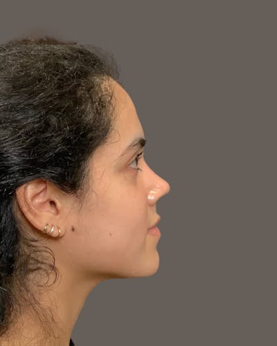 Rhinoplasty Before & After Gallery - Patient 320671 - Image 2