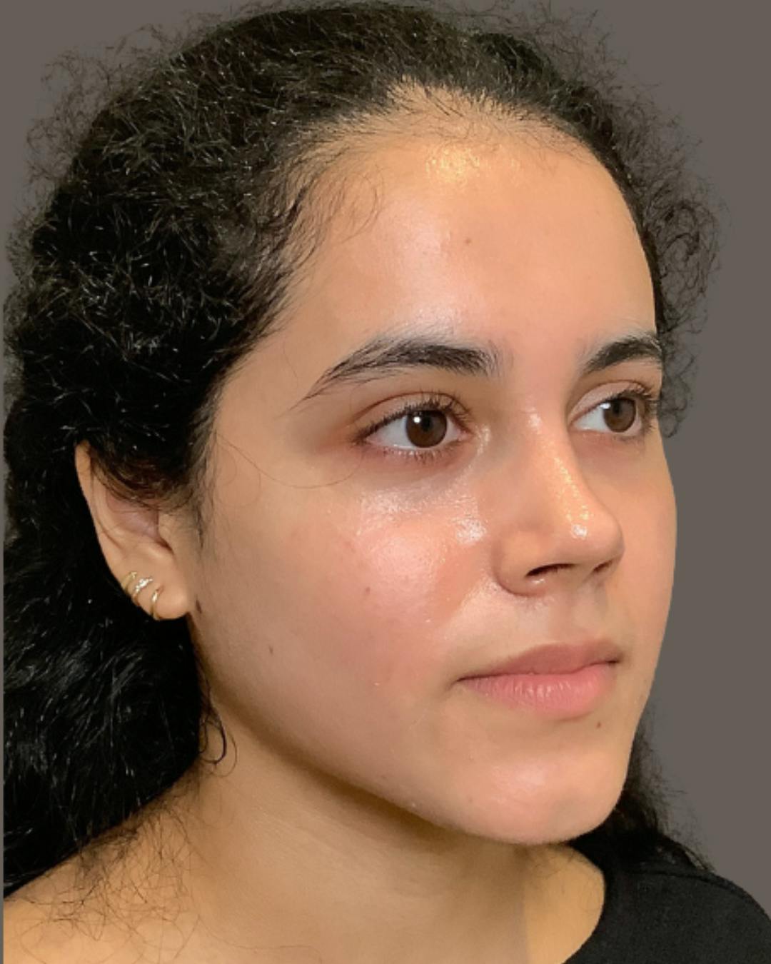Rhinoplasty Before & After Gallery - Patient 320671 - Image 4