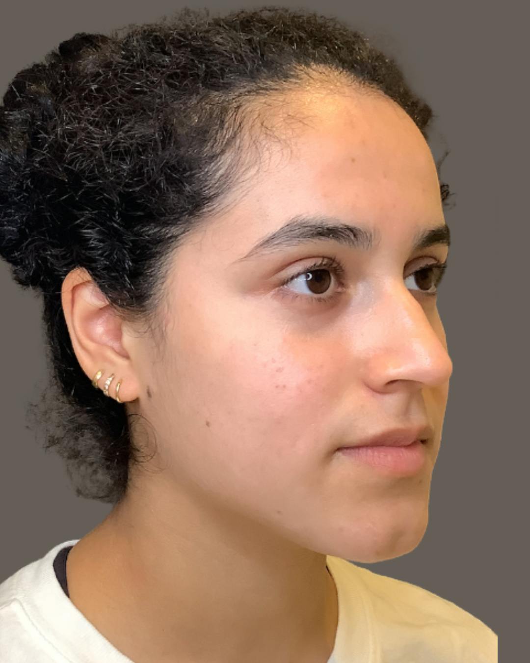 Rhinoplasty Before & After Gallery - Patient 320671 - Image 3