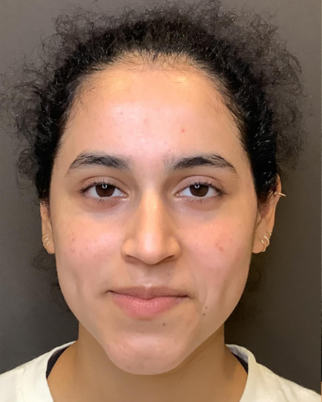 Rhinoplasty Before & After Gallery - Patient 320671 - Image 5