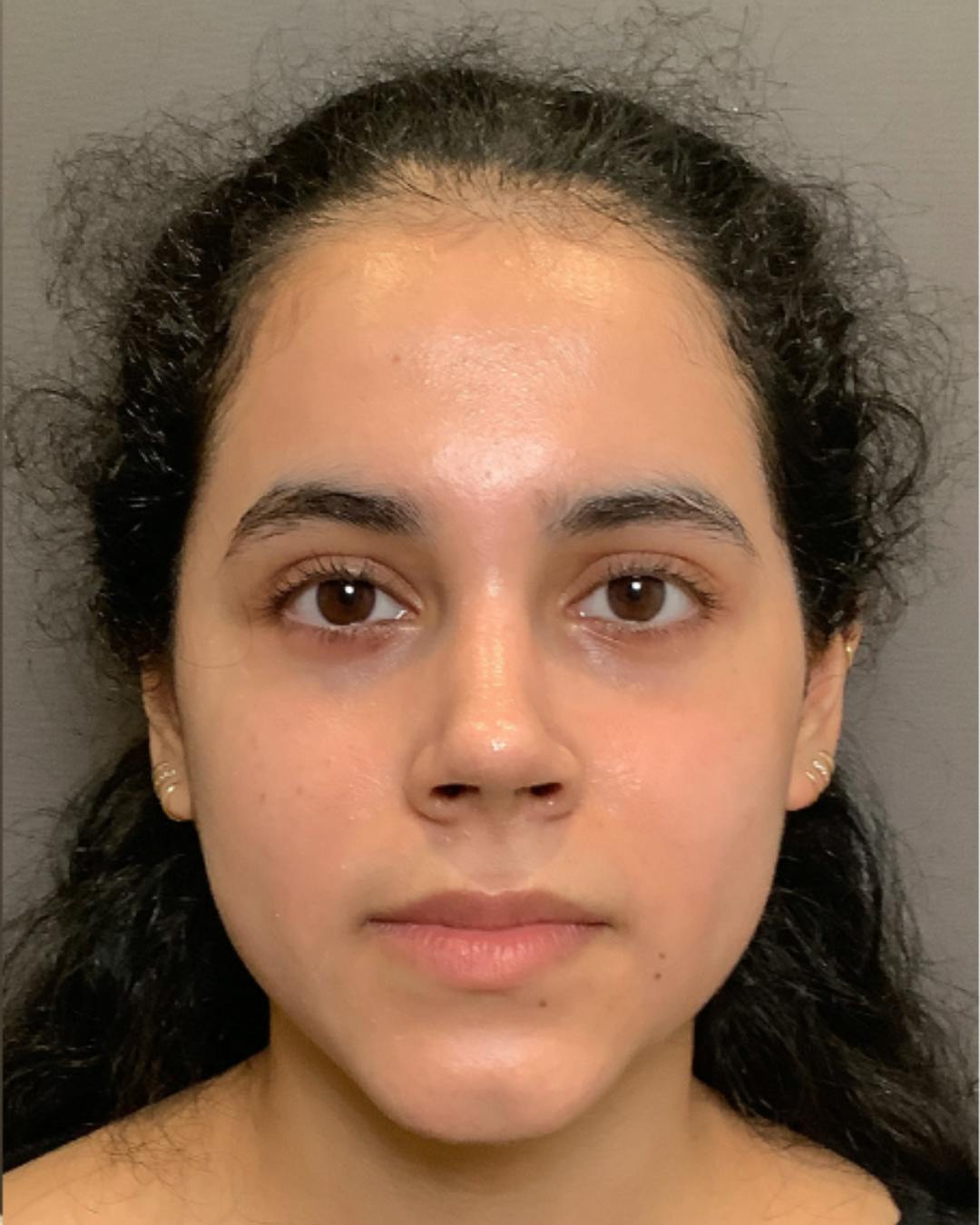Rhinoplasty Before & After Gallery - Patient 320671 - Image 6