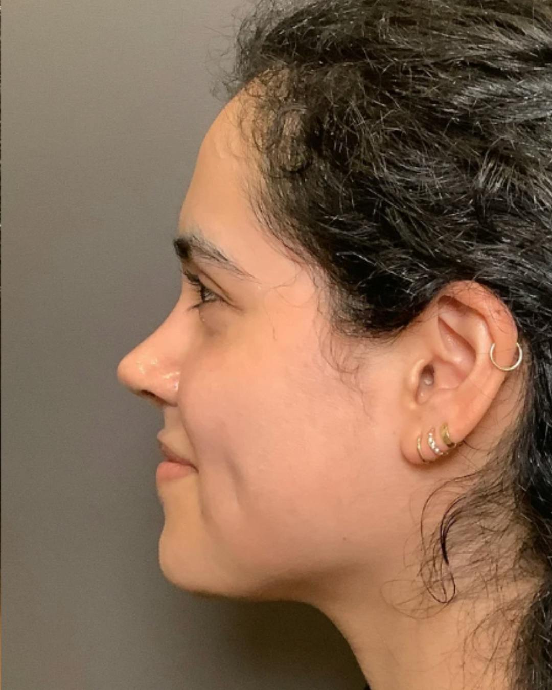 Rhinoplasty Before & After Gallery - Patient 320671 - Image 10