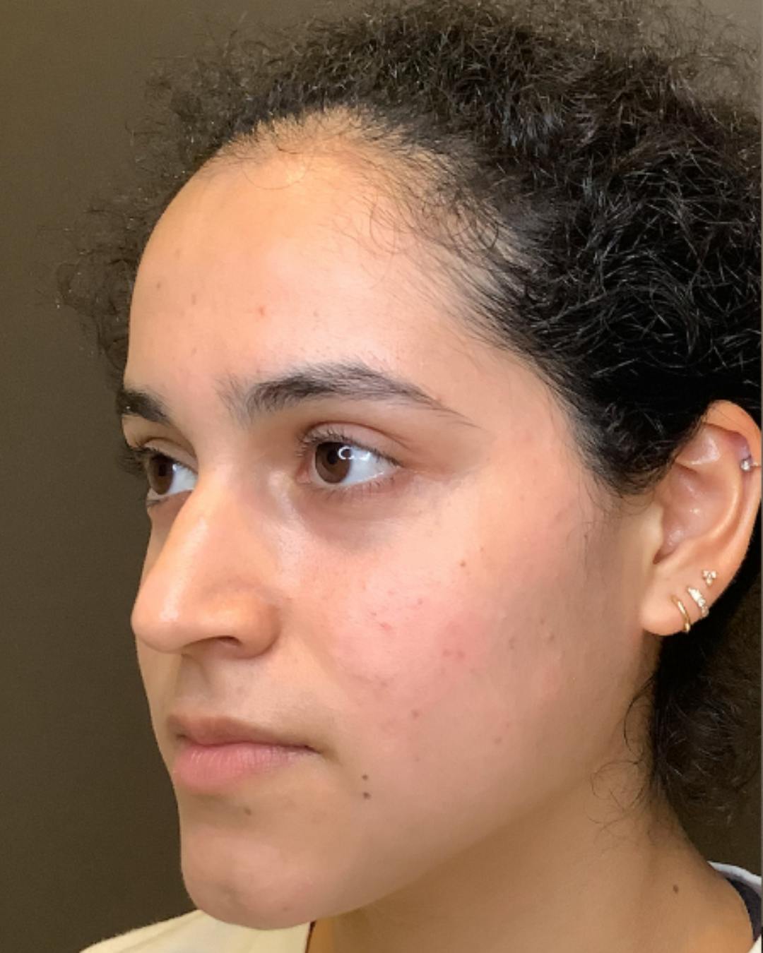 Rhinoplasty Before & After Gallery - Patient 320671 - Image 7
