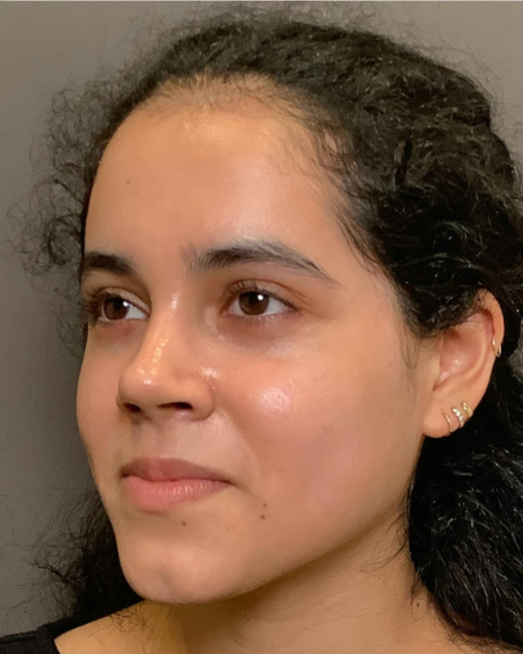 Rhinoplasty Before & After Gallery - Patient 320671 - Image 8
