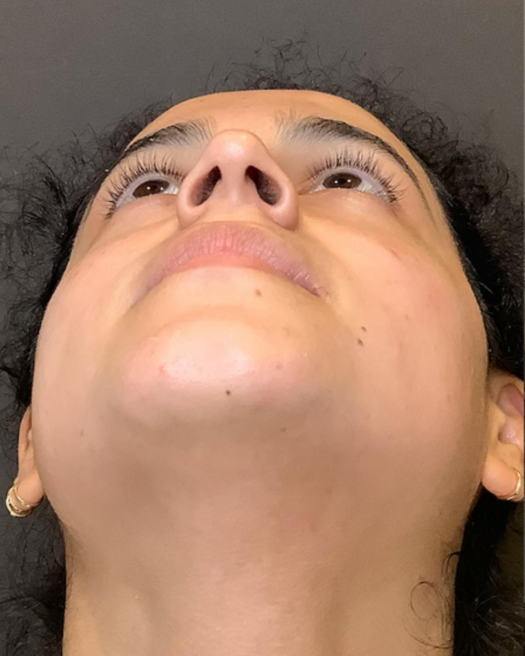 Rhinoplasty Before & After Gallery - Patient 320671 - Image 12