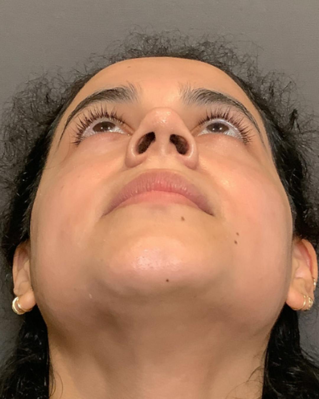 Rhinoplasty Before & After Gallery - Patient 320671 - Image 11
