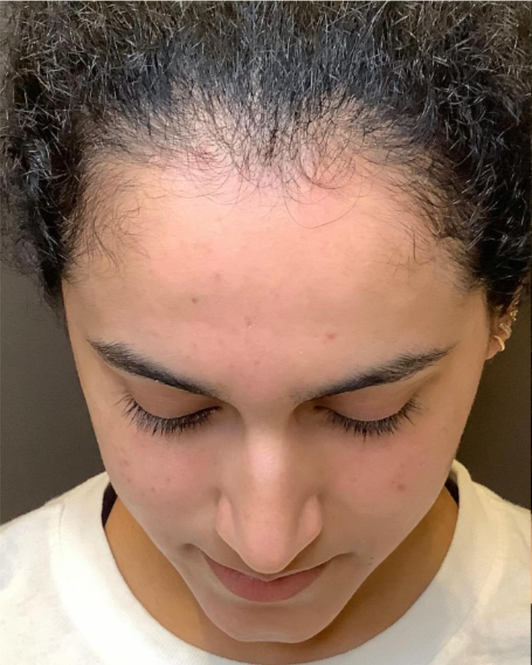 Rhinoplasty Before & After Gallery - Patient 320671 - Image 14