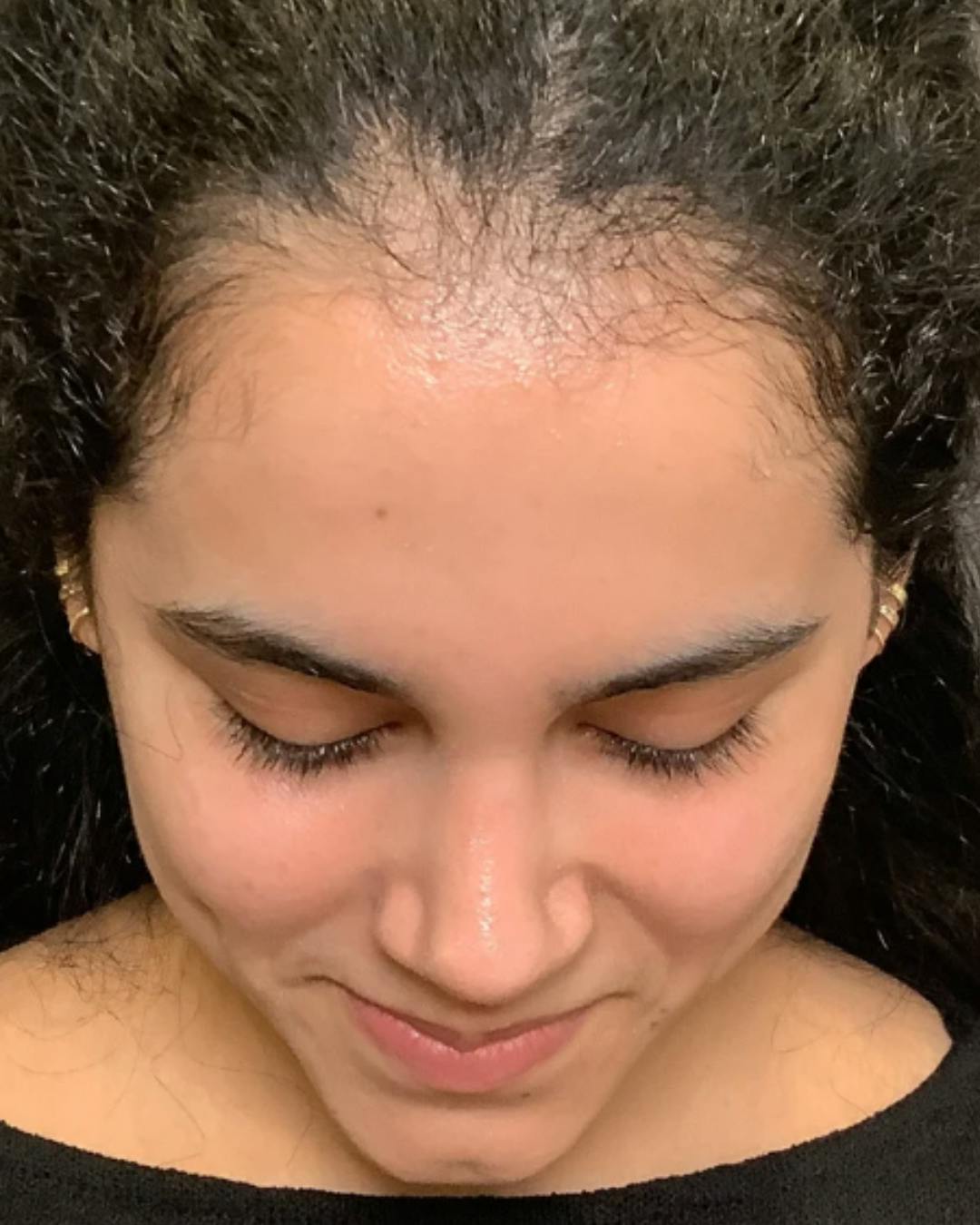 Rhinoplasty Before & After Gallery - Patient 320671 - Image 13