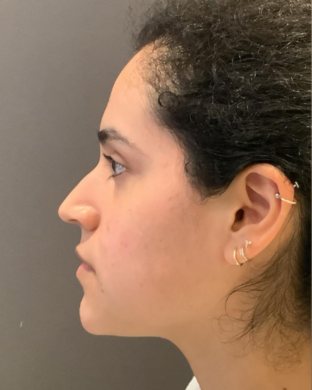 Rhinoplasty Before & After Gallery - Patient 320671 - Image 9