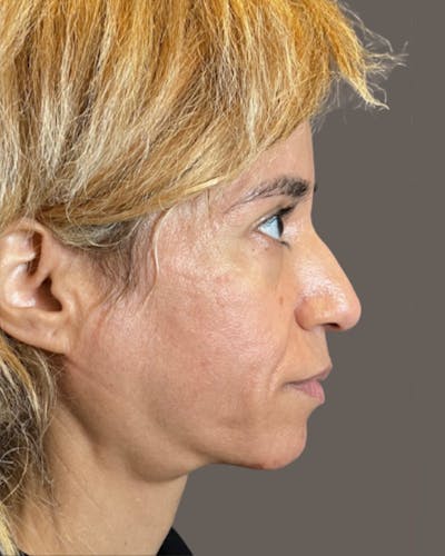 Rhinoplasty Before & After Gallery - Patient 288614 - Image 1
