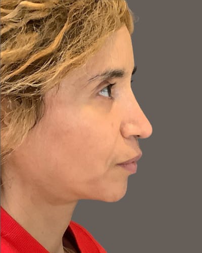 Rhinoplasty Before & After Gallery - Patient 288614 - Image 2