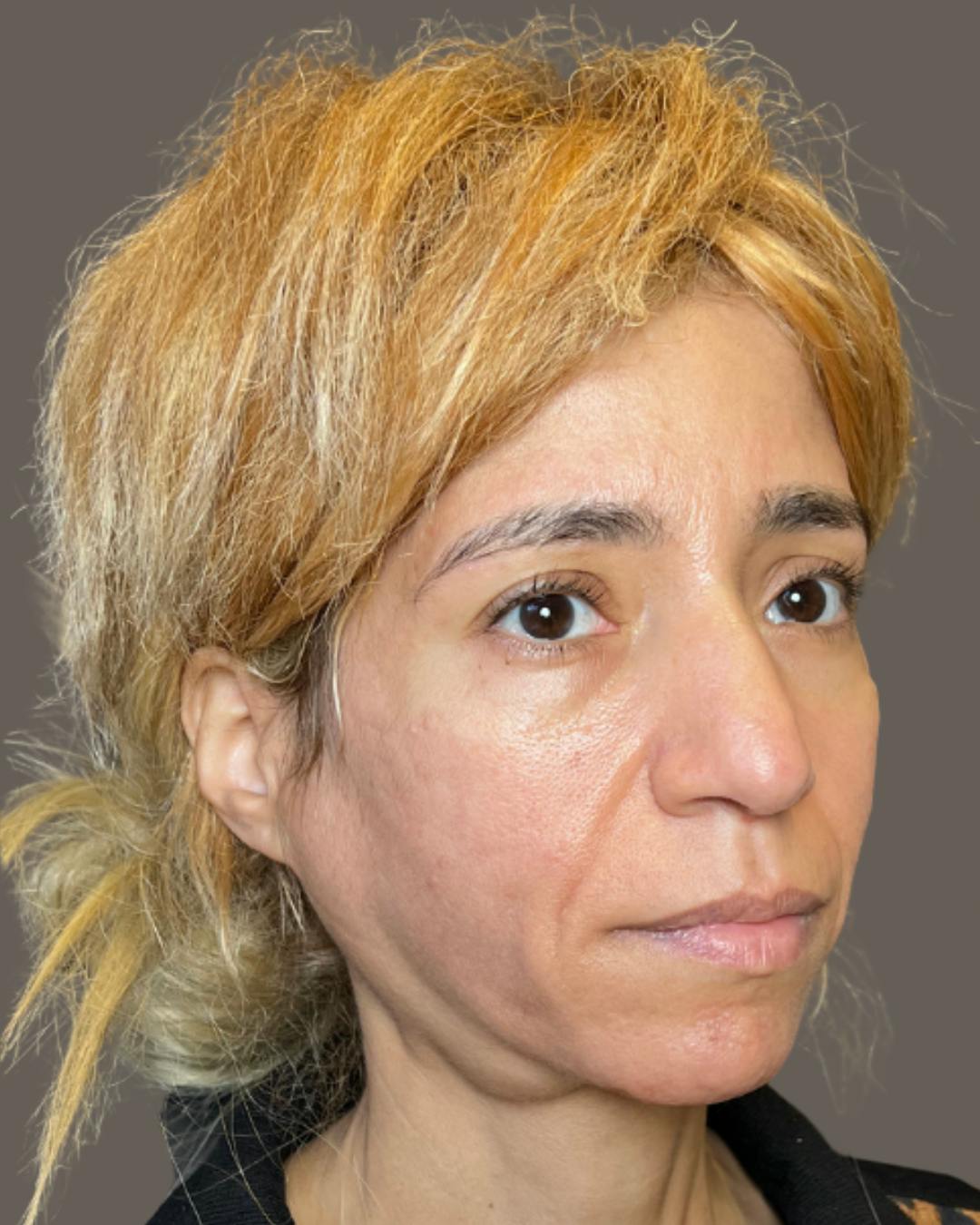 Rhinoplasty Before & After Gallery - Patient 288614 - Image 3