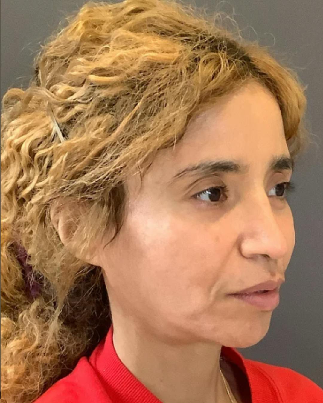 Rhinoplasty Before & After Gallery - Patient 288614 - Image 4