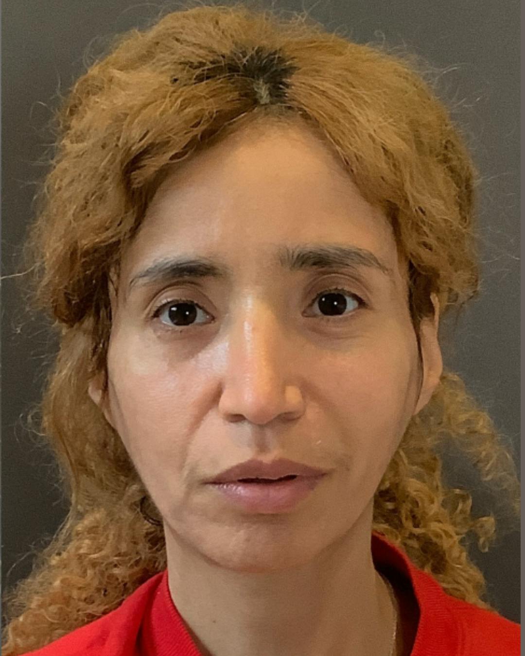 Rhinoplasty Before & After Gallery - Patient 288614 - Image 6