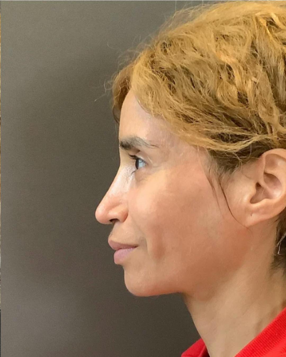 Rhinoplasty Before & After Gallery - Patient 288614 - Image 10