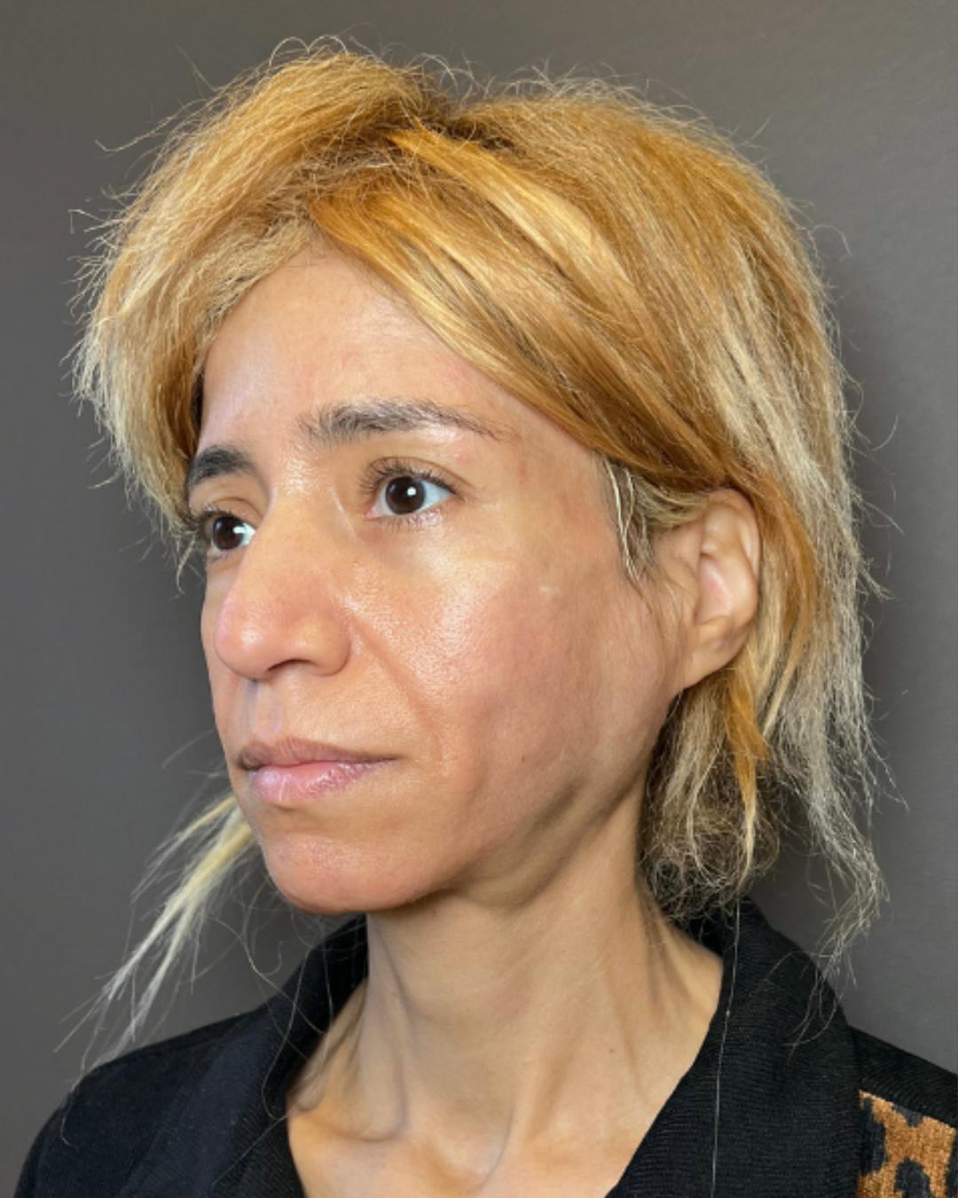 Rhinoplasty Before & After Gallery - Patient 288614 - Image 7