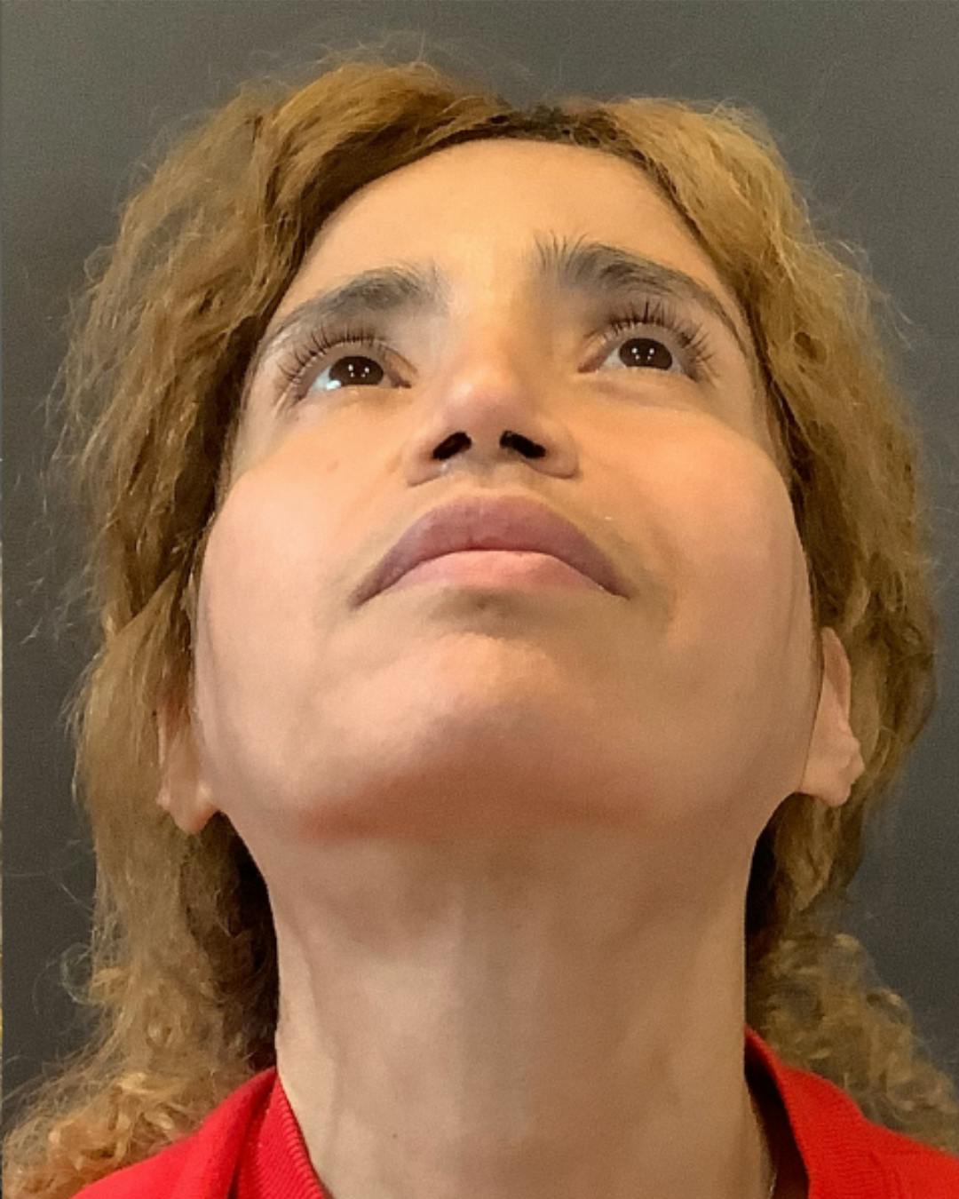 Rhinoplasty Before & After Gallery - Patient 288614 - Image 12