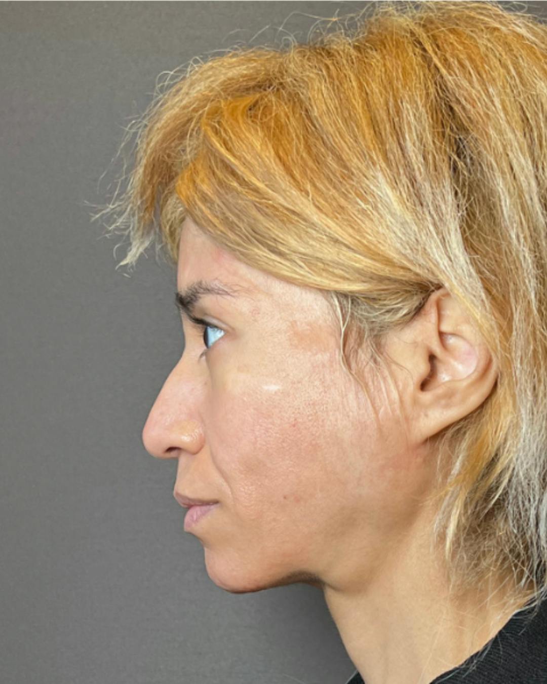 Rhinoplasty Before & After Gallery - Patient 288614 - Image 9