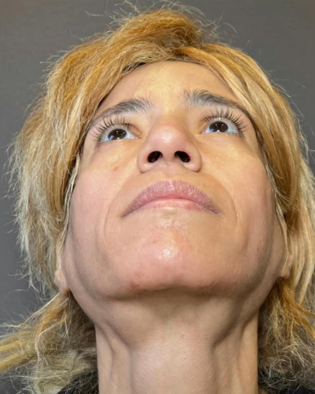 Rhinoplasty Before & After Gallery - Patient 288614 - Image 11