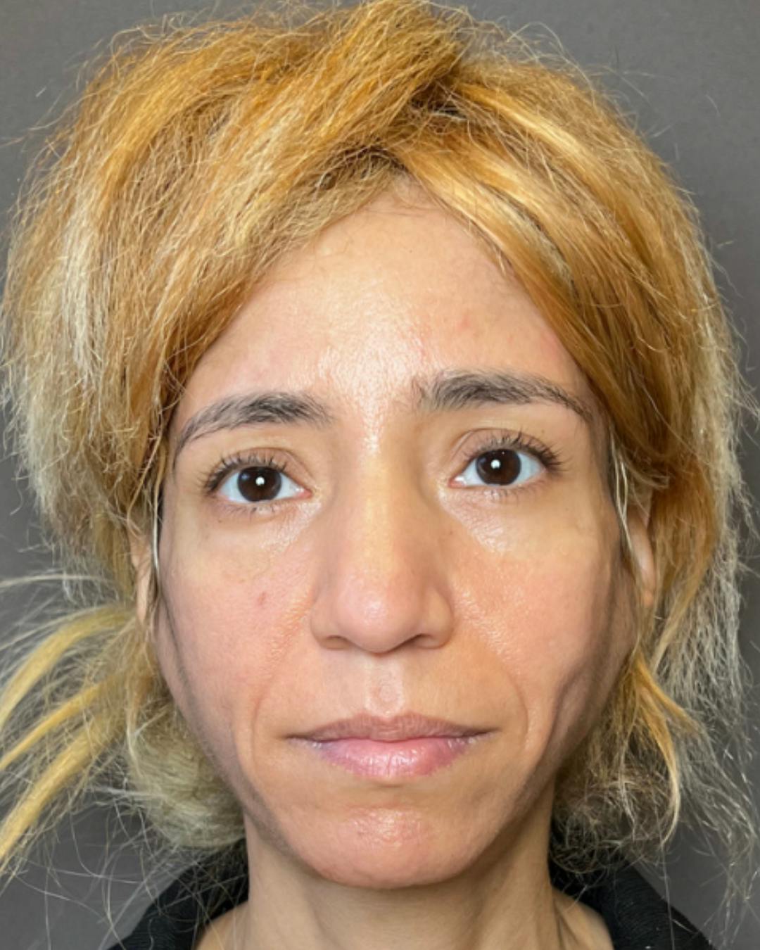 Rhinoplasty Before & After Gallery - Patient 288614 - Image 5